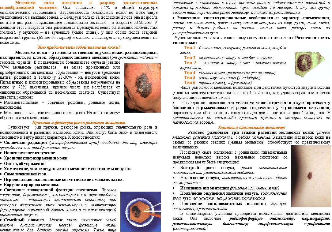 меланома