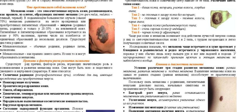 меланома