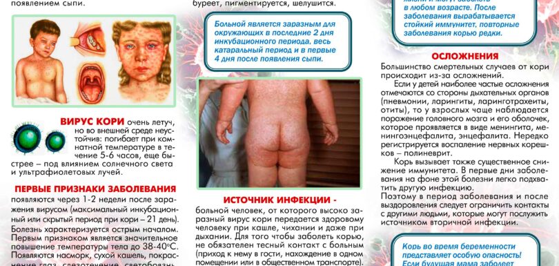 Как защитить себя и детей от кори Переиздание 2023 Оборот